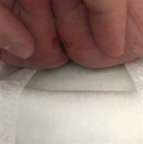 Diaper Candidiasis Vs Diaper Rash