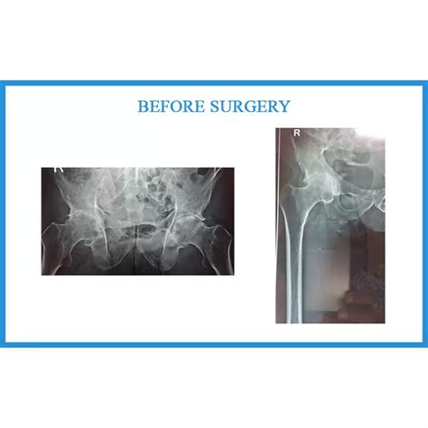 Gopal Maliwal Ankylosing Spondylitis - Dr Samir Nanavati