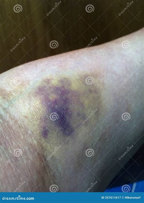 Weak After Blood Draw Phlebotomy - O arm is sore after blood draw