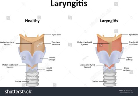 How Long Do Laryngitis Last