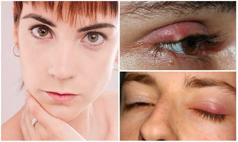 ¿Sabes por qué salen orzuelos? La culpable suele ser una bacteria