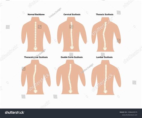 Types Scoliosis Medical Anatomical Vector Illustration Stock Vector (Royalty Free) 2396420575 ...