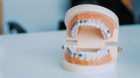 Screwless Dental Implants Overview United States 2026 - mytips.com