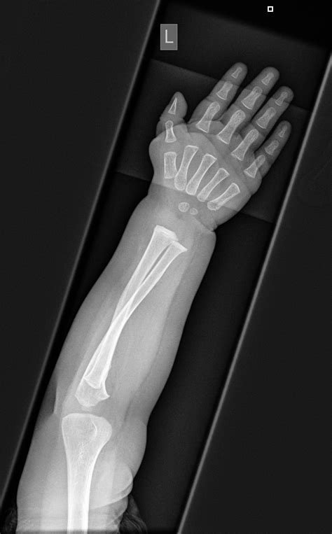 NORMAL PEDIATRIC BONE XRAYS - BoneXray.com