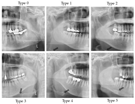 A Basic Study for Predicting Dysphagia in Panoramic X-ray Images Using ...