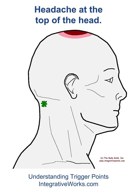 Headache on the Top of Your Head Cervicogenic Headache | Trigger points, Headache top of head ...