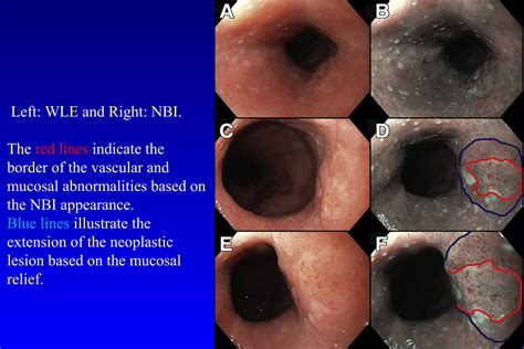 Barrett's esophagus; guidelines & new endoscopic techniques | PPT