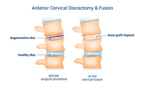 Medical Miscoding of Spinal Procedures: Common Pitfalls and Tips for Success | Quandary Peak ...