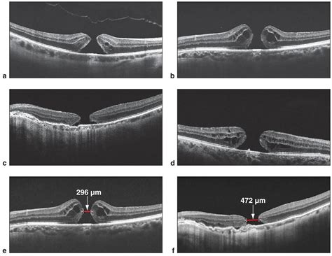 Macular Hole