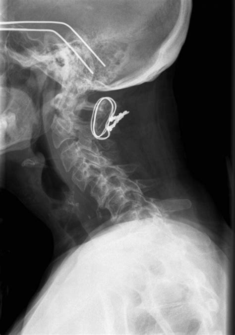 Dropped-head syndrome resulting from injury to the central spinal cord ...