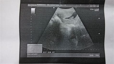 B超检查孕囊为1.7~2.3.但是3天后药流出来的白色孕囊有蛋黄大小椭圆形，有5厘米直径，这是30几天怀孕的么 - 百度宝宝知道