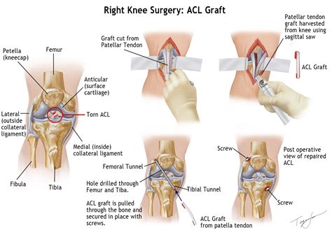 Knee treatments - kneesafe.com