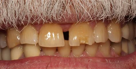 Dental Bonding In NYC | Before And After Photos