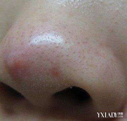 鼻子两侧有红血丝还起干皮怎么办？是脂溢性皮炎吗？