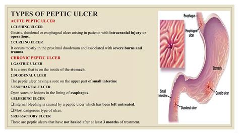 Peptic ulcer disease | PPTX