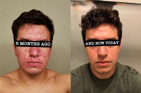 [B&A] 6 months ago today I began my skincare journey. From having the worst skin of anybody I ...