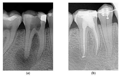 Success Of Endodontic Treatment at Jessica Bullard blog