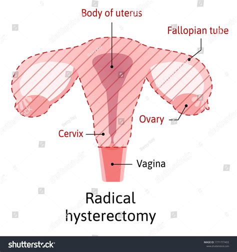 Uterus Cervix Removal After