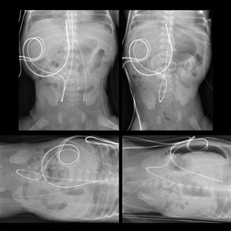 What A Brain X Ray Shows About An Ng Tube Placement