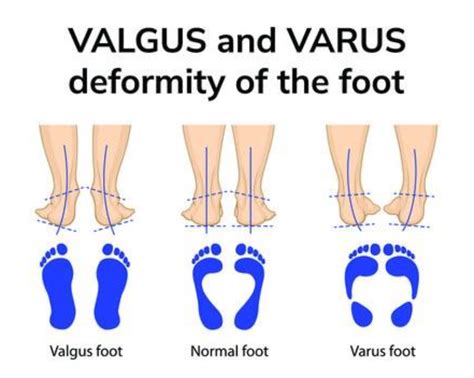 Picking the Right Shoe for your Orthotics
