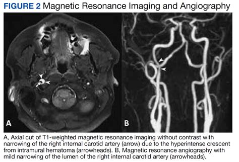 Acute Painful Horner Syndrome as the First Presenting Sign of Carotid ...
