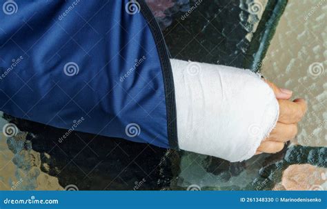 Broken Arm with Plaster Cast in Wearing Bandage To Support Injured Arm ...