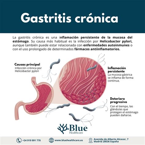 Gastritis crónica: causas, síntomas, diagnóstico y tratamiento