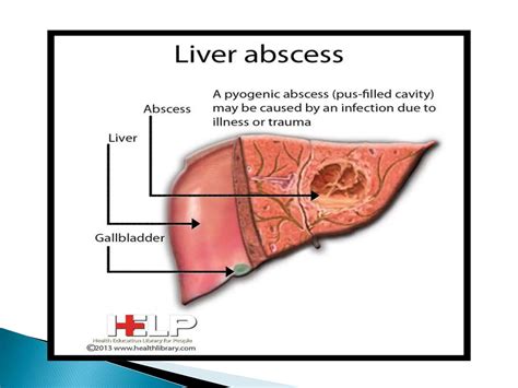 HEPATIC ABSCESSES liver problems ahn.pptx