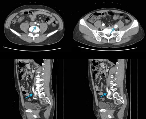 Isolated common iliac artery dissection and aneurysm | BMJ Case Reports