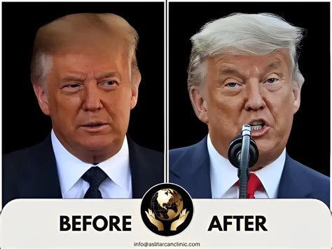 100 Celebrity Hair Transplants: Before And After Results