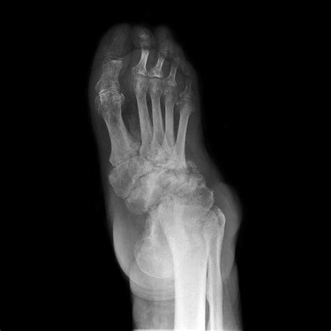 Image:Neurogenic Arthropathy of the Foot-MSD Manual Professional Edition
