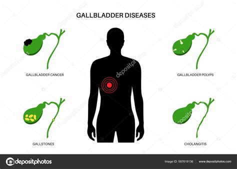 Gallbladder Diseases Infographic Gallstone Cancer Acute Cholecystitis Psc Polyps Digestive Stock ...