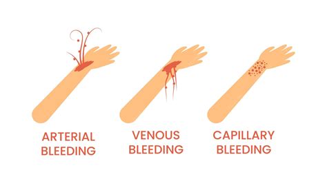 Premium Vector | Doctor Help Types Of Bleeding Venous Arterial Capillary First Aid Cartoon ...