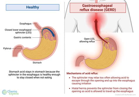Heartburn | ChemoExperts