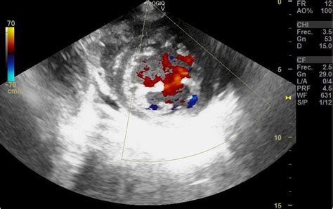 Echocardiography features of non-compaction cardiomyopathy | Medicina Intensiva