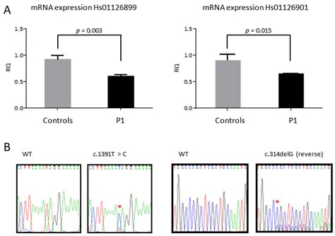 Two Novel Variants in YARS2 Gene Are Responsible for an Extended MLASA ...