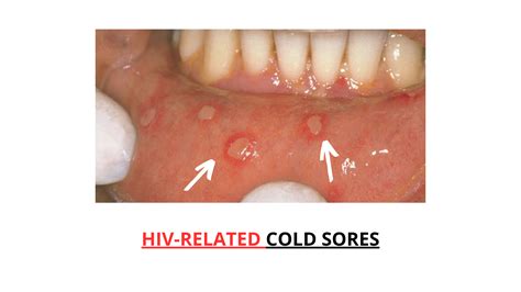 HIV Mouth Sores: A Complete Visual Guide with Pictures