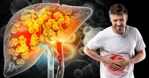 Fatty Liver Grade 2: Is it Dangerous? Causes, Symptoms, Treatment, and – IMMUNOSCIENCES