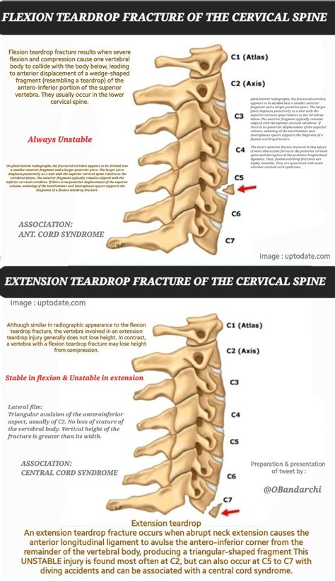 Flexion Vs Extension Teardrop Fracture