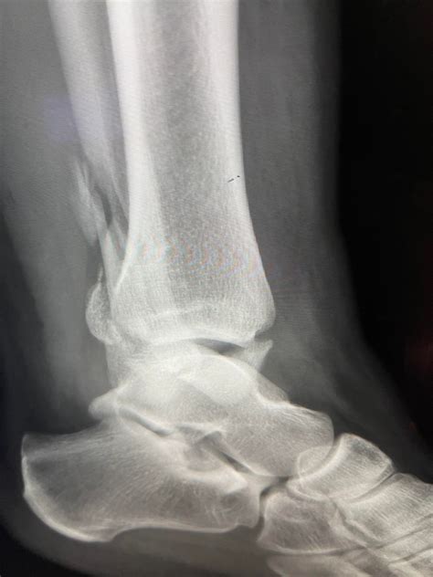 Deltoid ligament tear… no broken bones!! : r/Neverbrokeabone