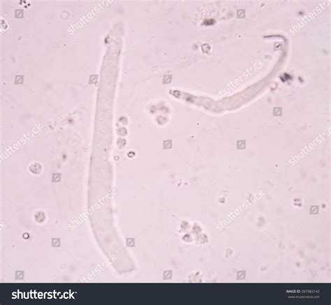 Hyaline Cast In Urine Casts | EClinpath