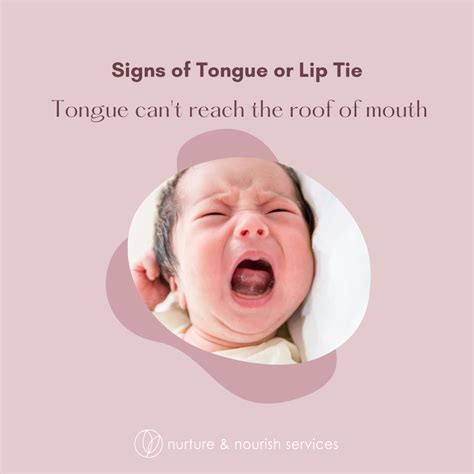 Visual Signs of Tongue Tie