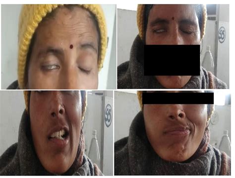 A Case Study on Bells Palsy and its Ayurvedic Management | AYUSHDHARA