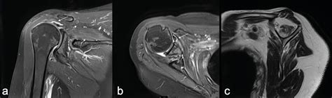 Versagensanalyse nach Rotatorenmanschettenrekonstruktion - Orthopädie ...