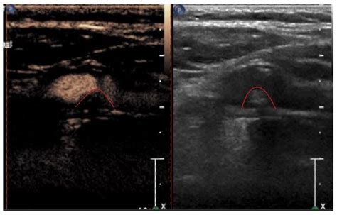 Assessment of Plaque Characteristics by Contrast-Enhanced Ultrasound ...