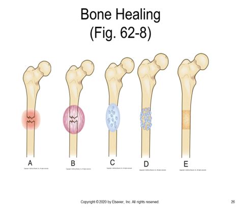 Image result for Bone Healing Process