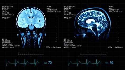 Image result for Add Brain Scan