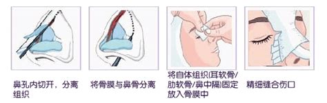 上海自体组织隆鼻_肋软骨/耳软骨隆鼻多少钱_上海美莱医疗美容
