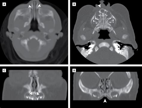 Congenital Nasal Pyriform Aperture Stenosis | Medical Devices and Equipment | JAMA ...