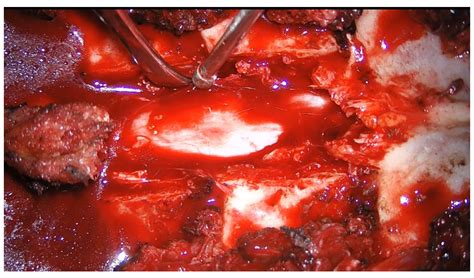 A Comparison of Laminectomy and Hemilaminectomy Approaches for ...